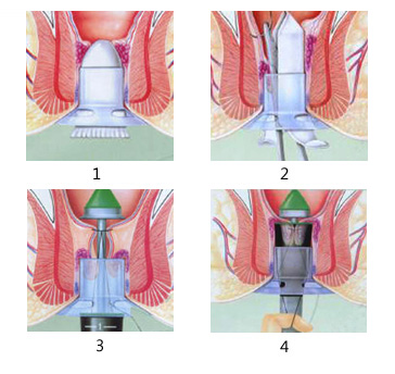 痔疮手术过程