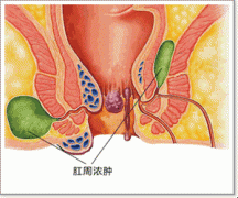 肛周脓肿示意图