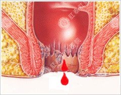 大便拉血是怎么回事？